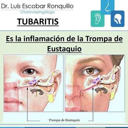 curando la disfuncion de la trompa de eustaquio