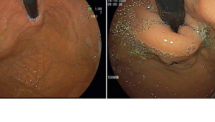 tiempo de recuperacion para el reflujo gastroesofagico